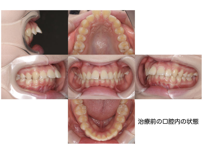 やみか歯科・矯正歯科　非抜歯矯正　出っ歯　すきっ歯　
