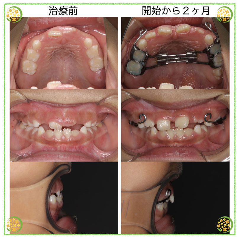 美しい 小児の反対咬合（受け口）2ヶ月間の変化 新大阪の歯医者｜や - 語学+参考書