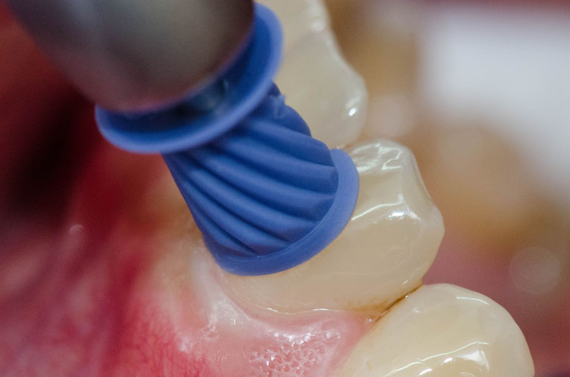 Dentalhygiene Prophylaxe - Freising - Zahnarztpraxis Dr. Thalmair