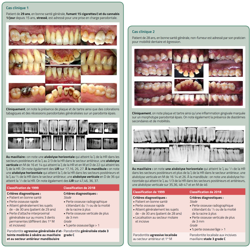 classification des récessions gingivales
