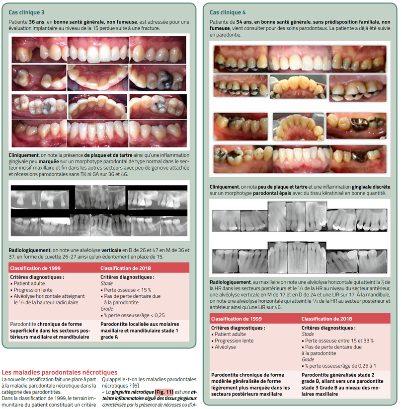 classification des récessions gingivales