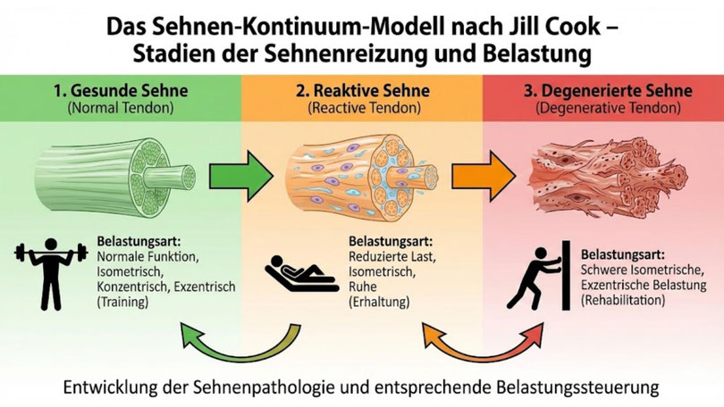 Grafik zum Sehnen-Kontinuum-Modell nach Jill Cook – Stadien der Sehnenreizung und Belastung.