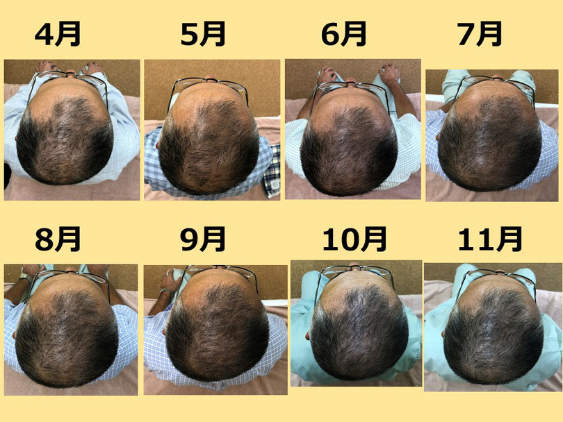 薄毛　鍼灸　つぼ　変化