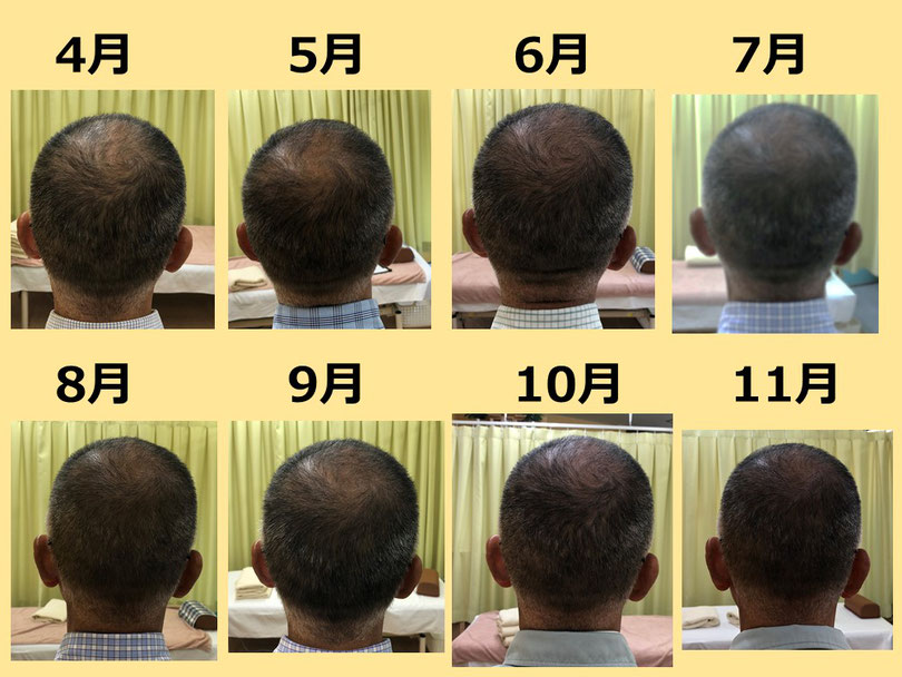 薄毛　鍼灸　つぼ　変化