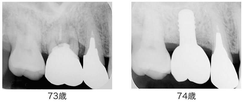 73歳と74歳の歯のレントゲン比較。インプラント治療前とインプラント治療後。