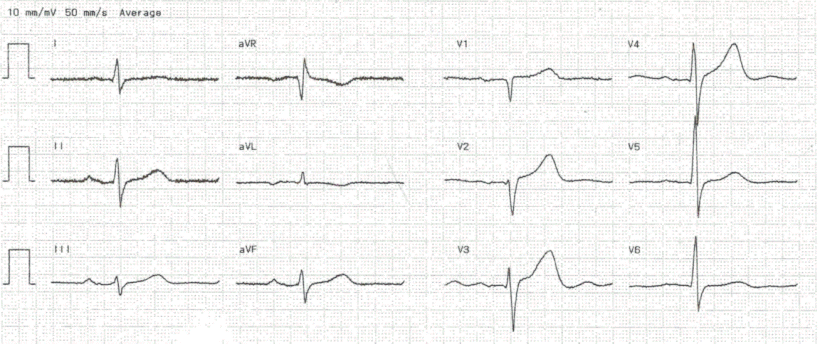 EKG schwere COPD