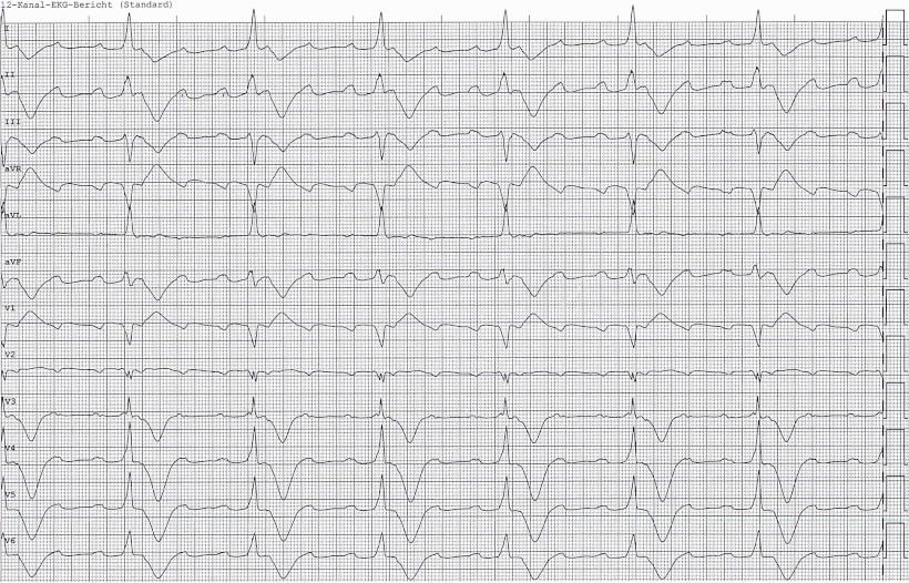 EKG Takotsubo-Kardiomyopathie Voranflattern