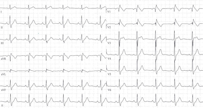 brugada-ekg