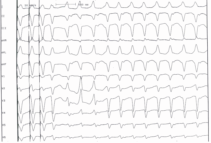 EKG Kammertachykardie ARVCM Programmierte Stimulation