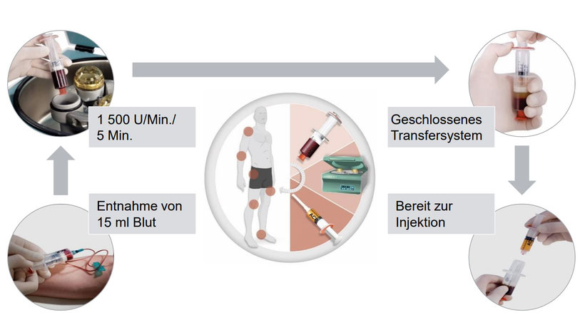 Orthopraxis Schwarzenbek - Mechanismus Eigenblutbehandlung (ACP)