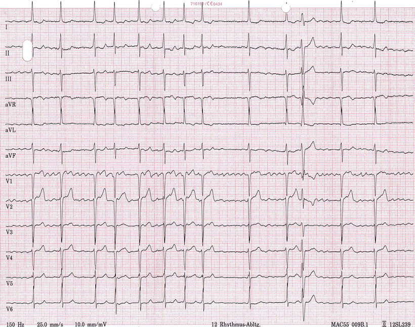 EKG Grobes Vorhofflimmern