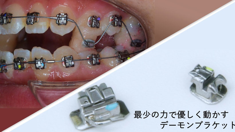 バイトアップ法で奥歯を引き出している写真（左上）、デーモンブラケット（右下）