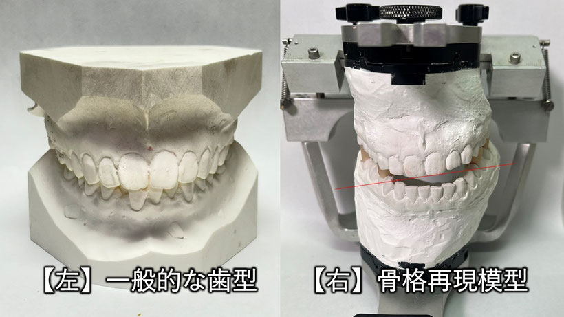 左はよく見かける平行模型、右は骨格と口の状態を正確に示した半調節性咬合器による模型