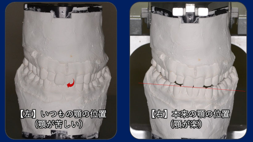 左の模型は普段噛んでいる位置、右の模型は筋肉がリラックスしたときに噛む位置（中心位）です