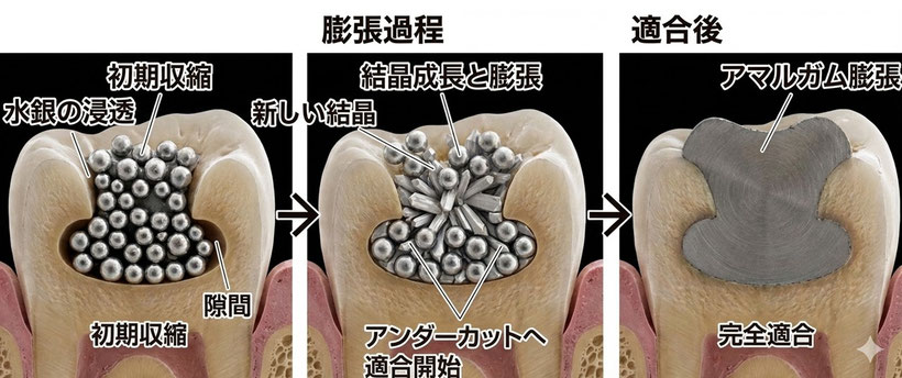 アマルガムはアンダーカットのある虫歯に詰めることができる唯一の金属材料です