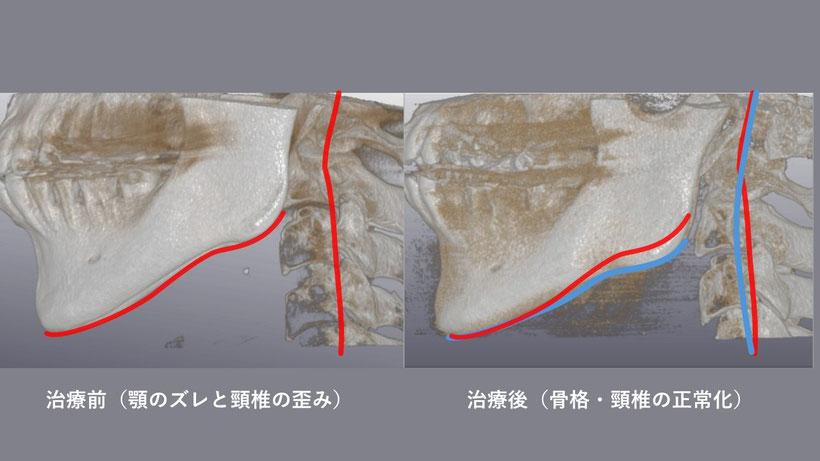 治療前と、治療後のCT写真の画像の比較です。左が治療前、右が治療後のものです。