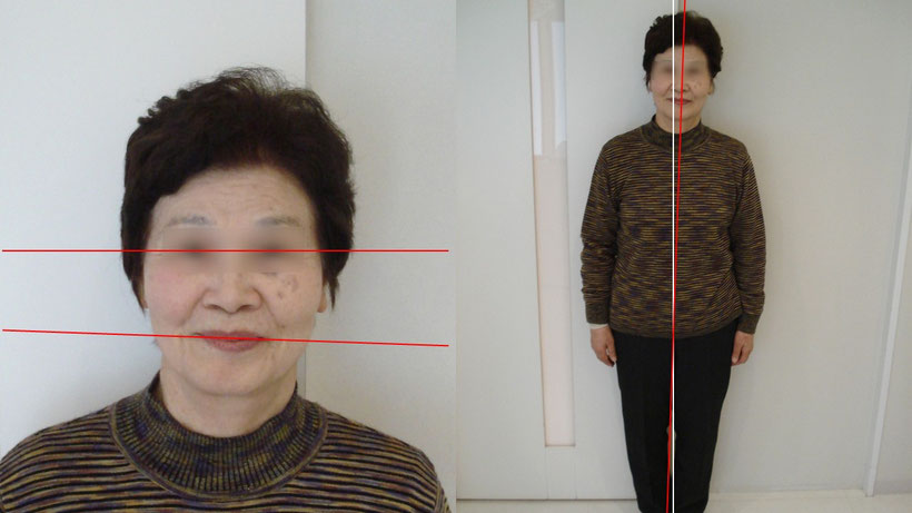 ノンクラスプデンチャーで右側だけ噛み合わせが低くなり、身体が傾いてしまった方の写真、左はいびつに歪んだ顔、右は建った時の姿勢が頭だけ左に傾いています。