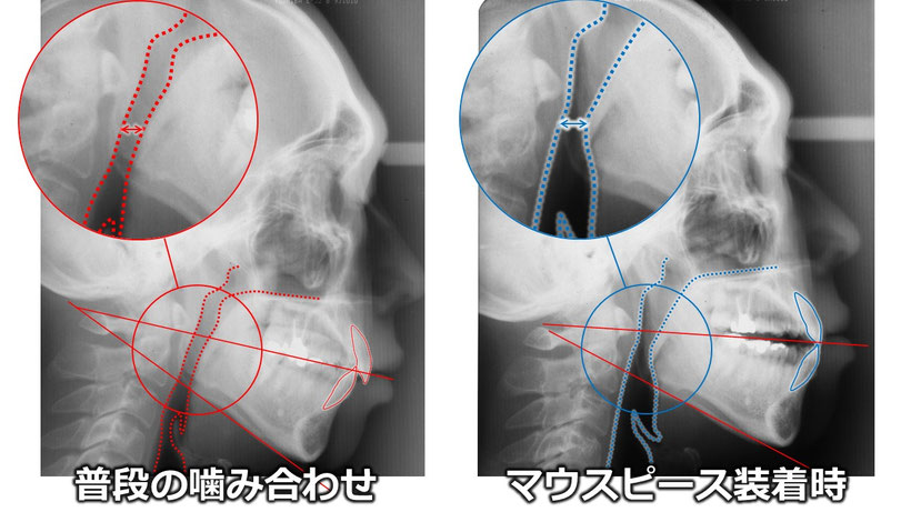 左は普段噛んでいるときのセファロレントゲン写真、右は顎を前に出した状態で撮影したもの、気道の広さが違っているのが分かる