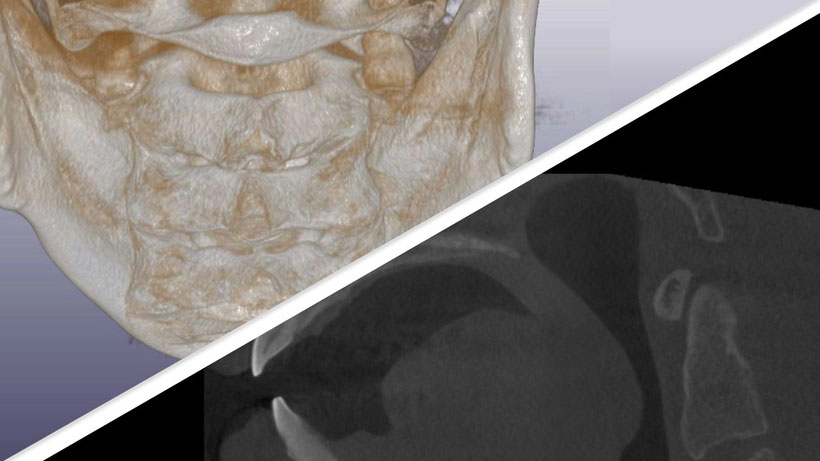 正常な骨格のCT3D映像（左上）、狭くなった気道を示すCT断層映像（右下）