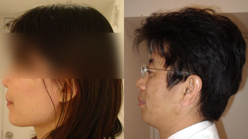 左はローアングルの噛み合わせが低い例、右はハイアングルで噛み合わせが低い例の写真