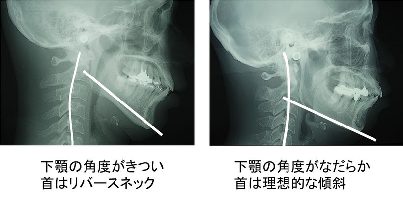 左の写真はハイアングルのセファロレントゲン写真、右はローアングルのセファロレントゲン写真
