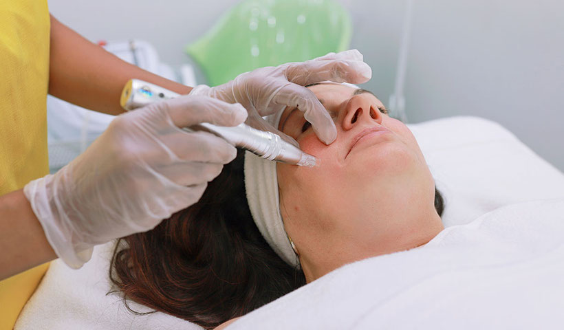 Microneedling bei Pérola Brasil Waxing und Beautystudio