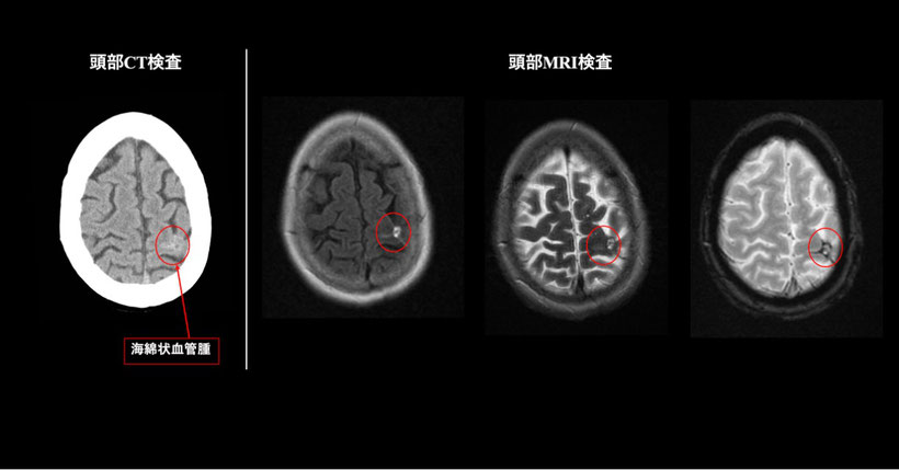 海綿状血管腫の頭部CT画像と頭部MRI画像の比較