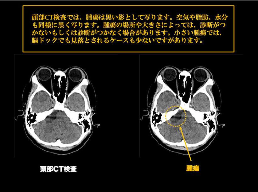 類上皮腫、類表皮腫、類表皮嚢胞の頭部CT画像