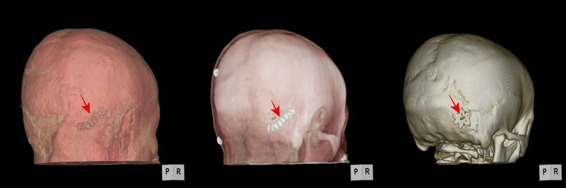 顔のどこか(顎や頬、歯)に激痛が走る三叉神経痛の手術部分　３次元頭部CT画像でわかりやすい