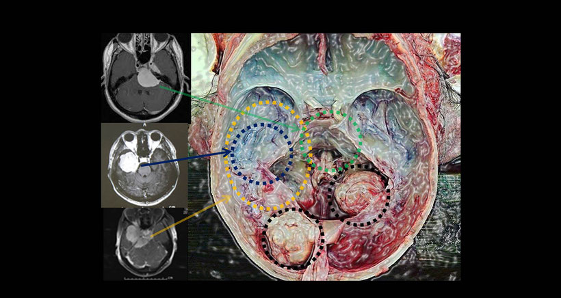 髄膜腫のMRI画像と剖検による髄膜種の画像との比較で、治療が難しい部位がわかります。