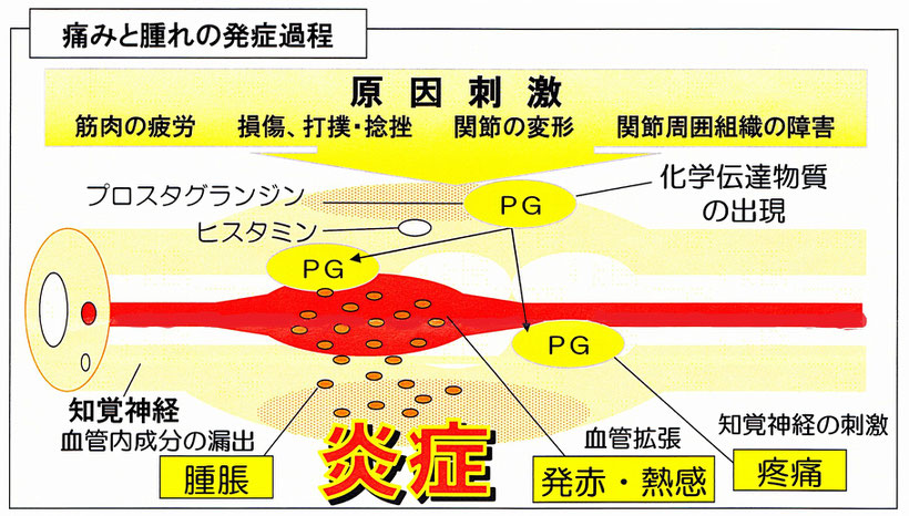 慢性の痛みの根本原因は、発痛物質の出現です。