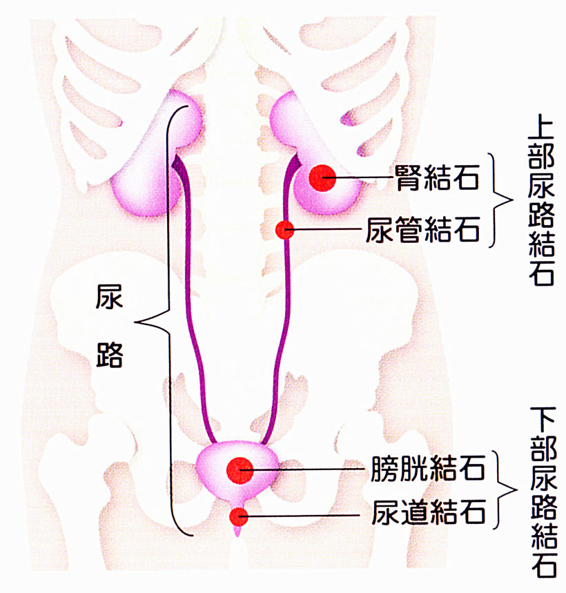尿路結石症は、腎結石、尿管結石、膀胱結石、尿道結石に分けられます。