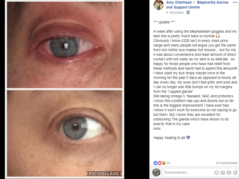 Vorher - Nachher Bild, nach Anwendung der Blephasteam Wärmebrille + der originale Erfahrungsbericht von Amy (Screenshot)