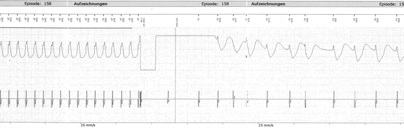 EKG ICD Schock