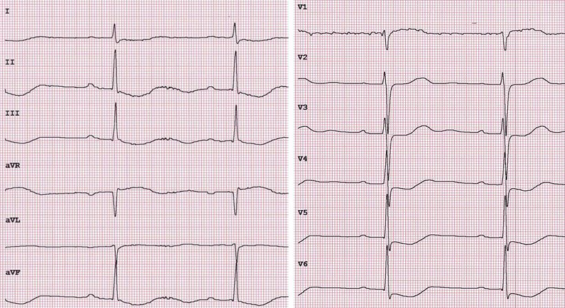 EKG Digitalis