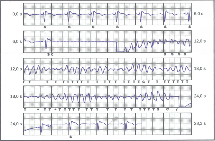 EKG tragbarer ICD Schock