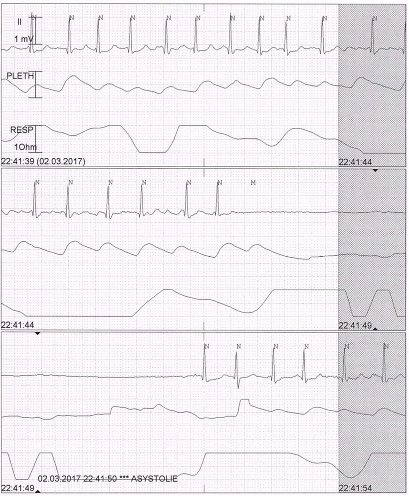 Vorhofflimmern - Fokus-EKG
