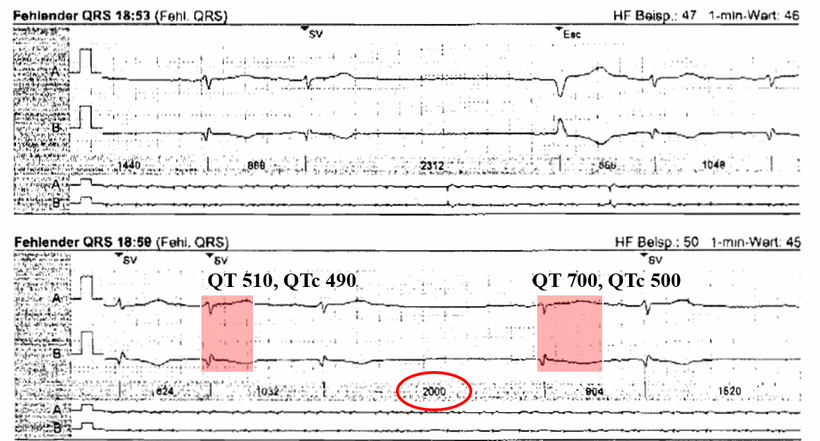 EKG Exzessive QT Verlängerung