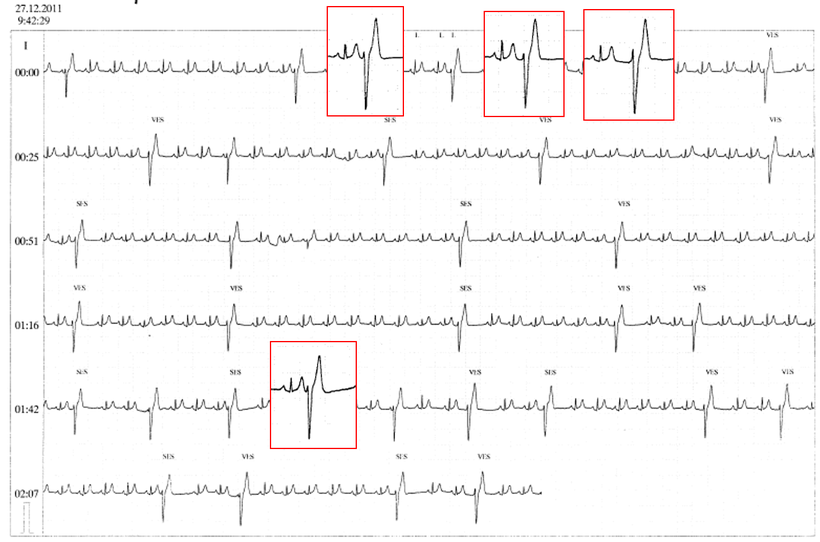EKG Akzelerierter Idioventrikulärer Rhythmus