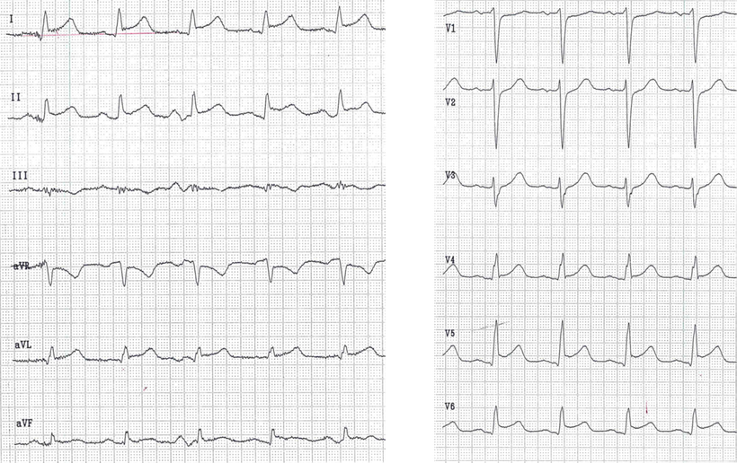 EKG Akuter Vorderwandinfarkt 