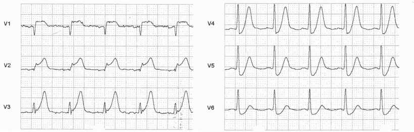 EKG Akuter Vorderwandinfarkt im Frühstadium Erstickungs-T