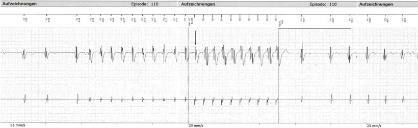 EKG ICD Burst-Stimulation