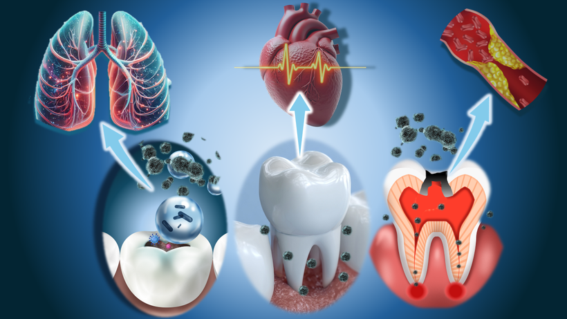 歯の細菌感染によって、心臓疾患、動脈硬化、認知症が起こる
