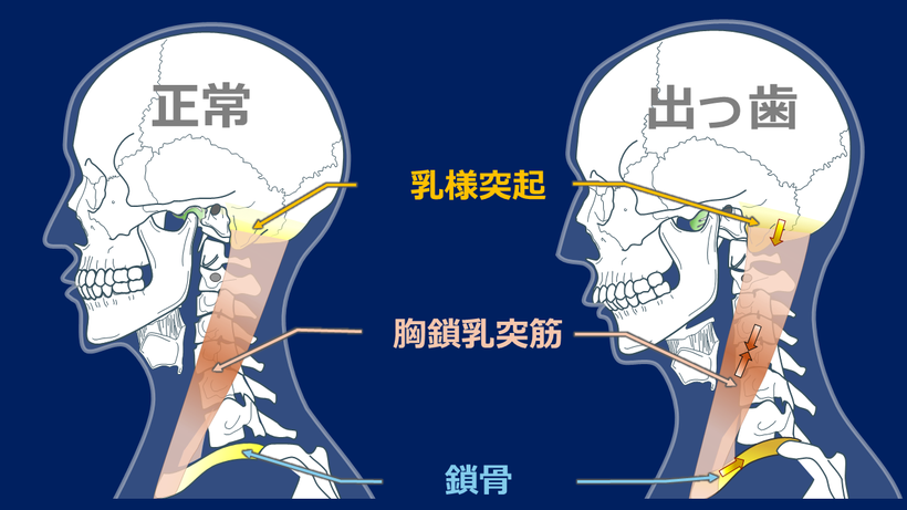 出っ歯と筋肉の反応、骨格の移動の関係、鎖骨、肩甲骨や舌骨、甲状軟骨が移動し、乳様突起が変形、頸椎は斜め後ろに引かれ変形