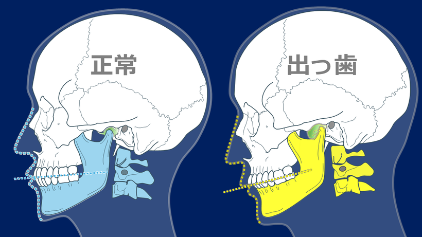 咬合平面が正常の人より後ろ上がりになります。
