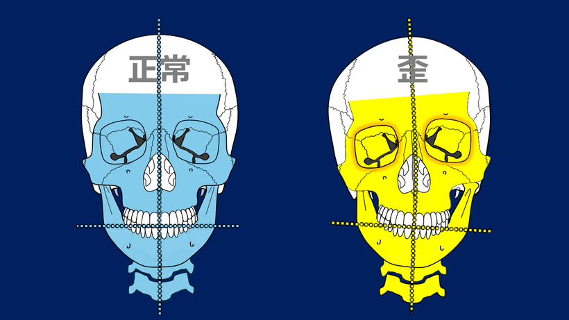 奥歯の高さが左右で変わる、骨が歪むなどで左右の歪が起こる