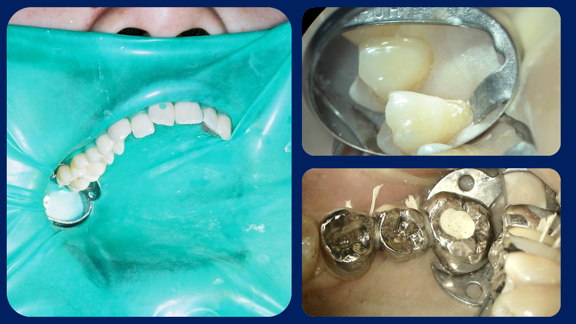 通常は10本法でラバーダムがかけられます。（左）、歯頚部（歯の根元）治療の時のラバーダム（右上）、ブリッジの時のラバーダム（右下）