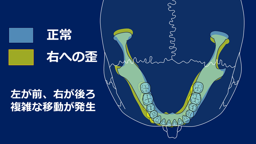 歪んだ側の顎関節が奥に入り、関節周囲の筋肉の緊張を強める