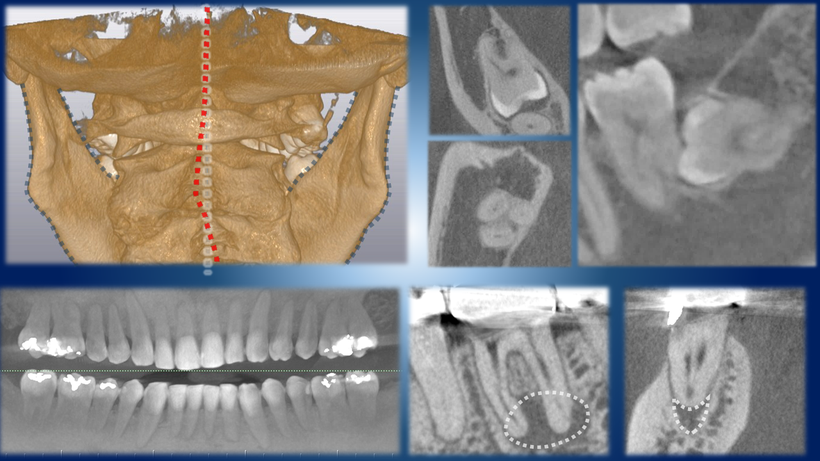 CTスキャンで得られる情報、顎の3次元像（左上）、埋伏歯と神経の関係（右上）、全体の歯の状態確認（左下）、根の状態詳細の確認（右下）
