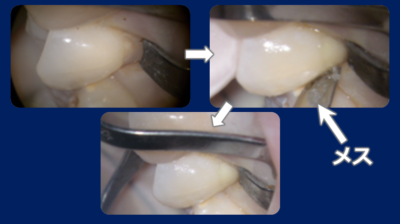 WDSの治療、WSD専用のクランプを使い、RIVAを充填、メスで仕上げます。